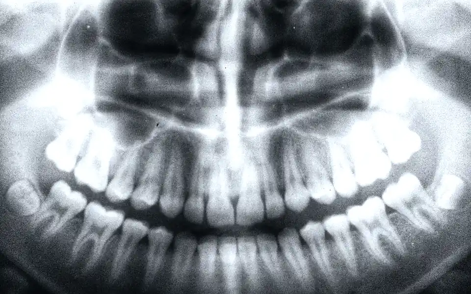 Patient smiling after implant treatment